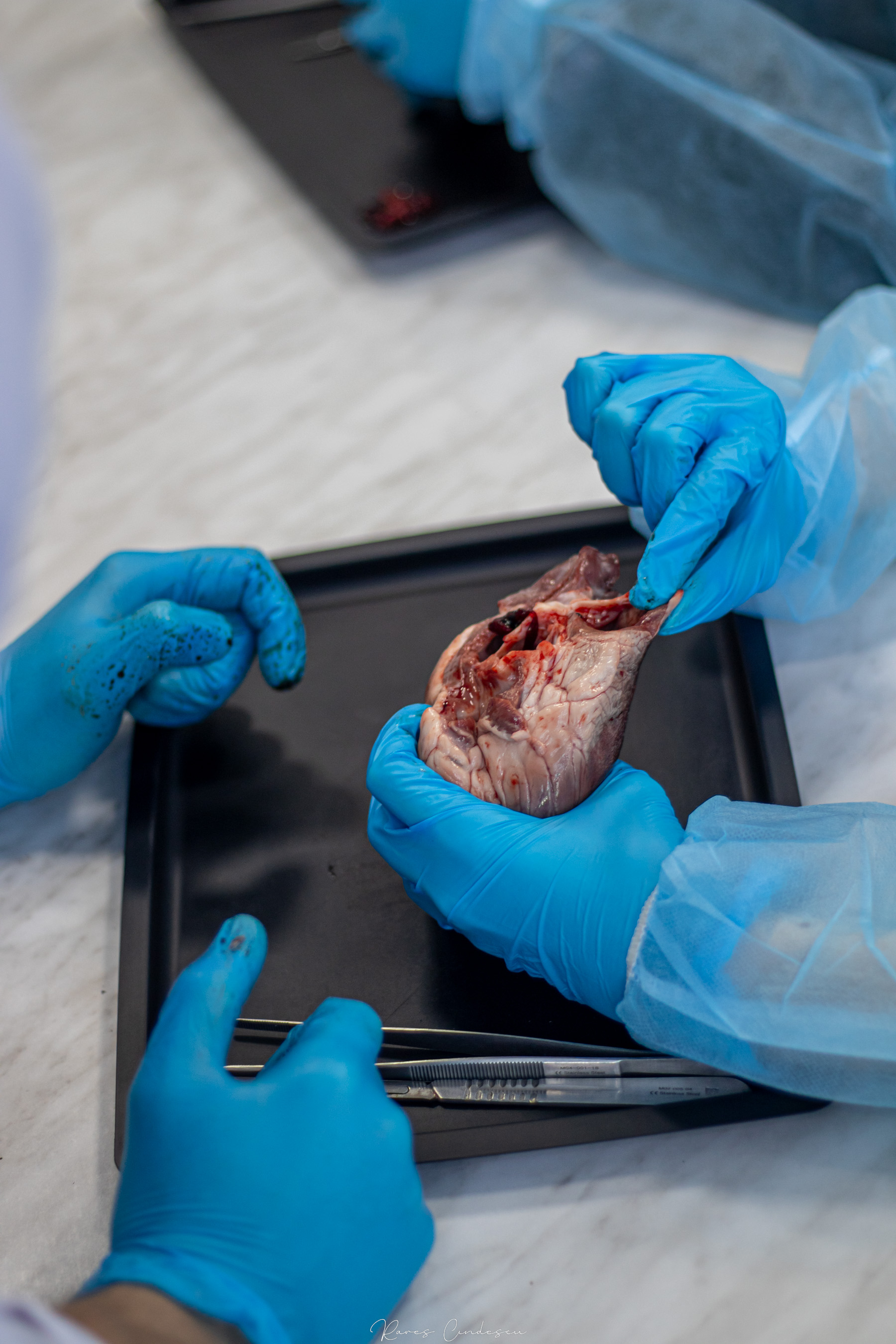 Disecție Valvulară