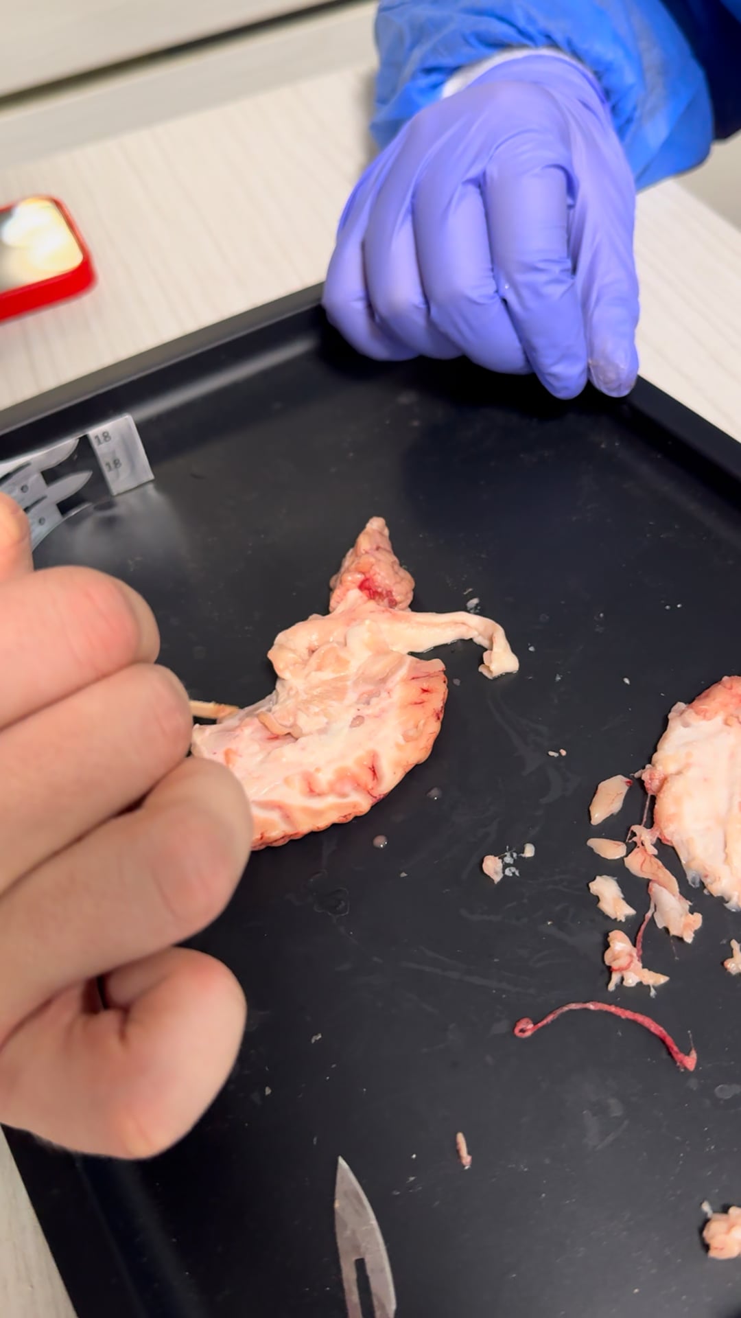 Disecție Cerebrală