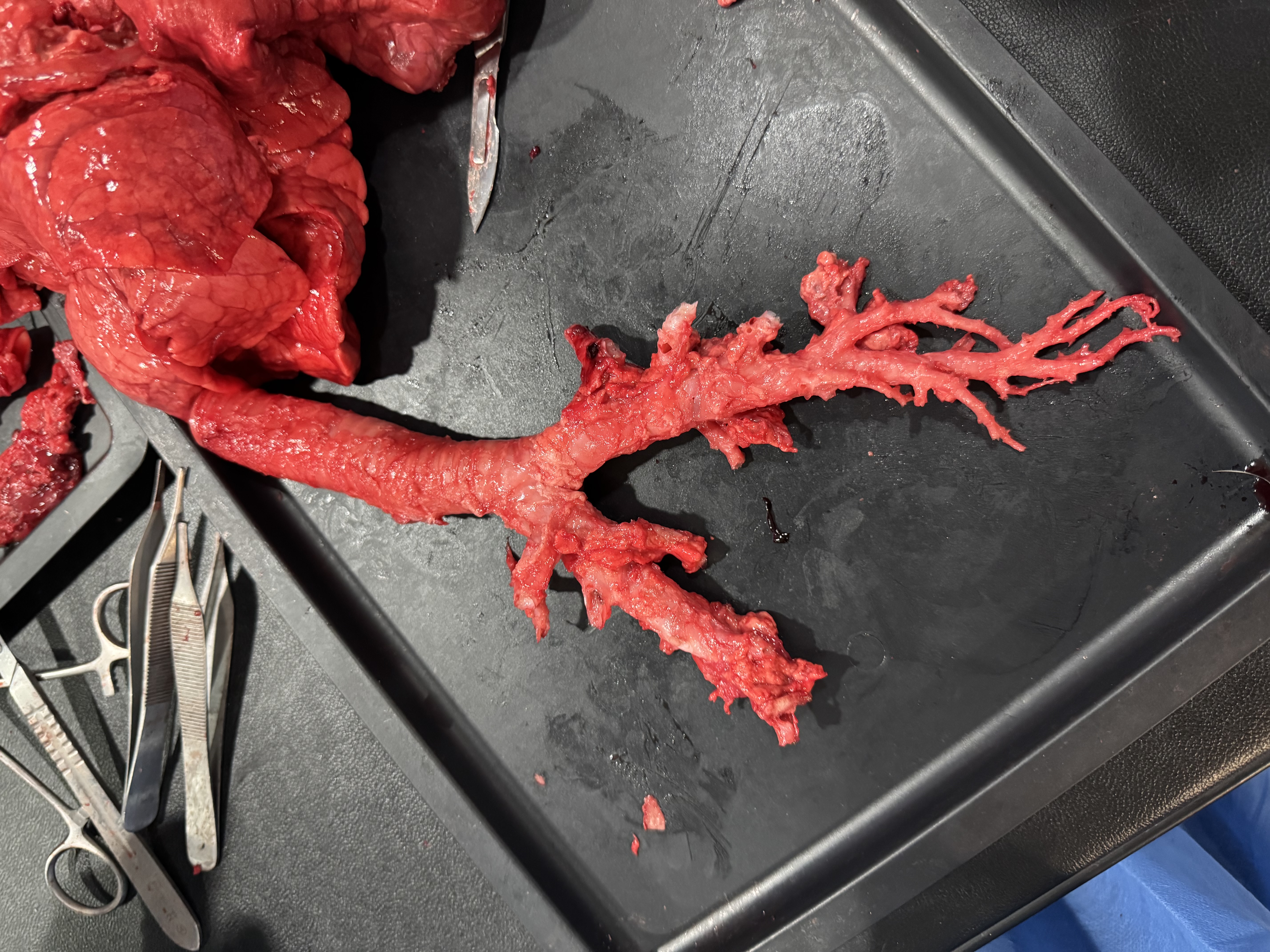 Disecție Pulmonară