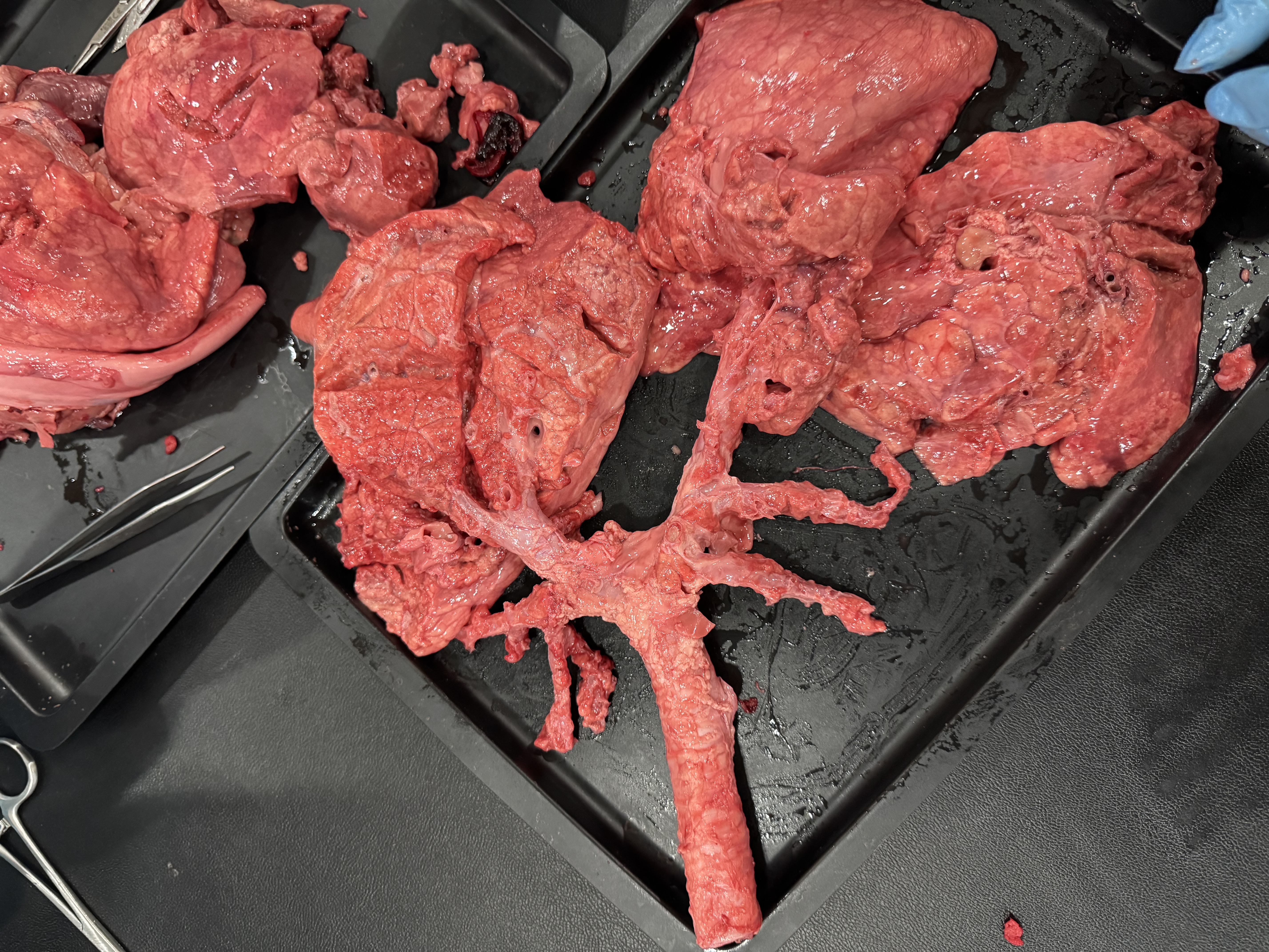 Disecție Pulmonară